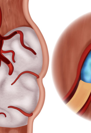 Biomaterials for safe & effective embolization  