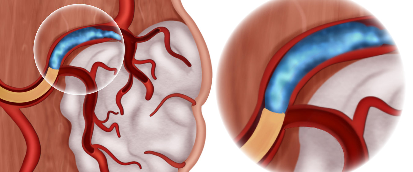 Biomaterials for safe & effective embolization  